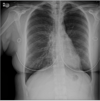 A Rare Case with Long-term Asthma Diagnosis: Swyer-James Macleod Syndrome