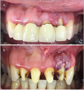 Management of Gingival Recession Around the Prosthesis