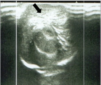 Ultrasonographic Findings in Acute Balanopostitis