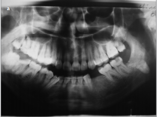 Surgical Management of Displaced Mandibular Third Molar Into the Submandibular Space