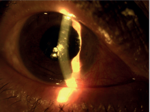 A Rare Clinical Entity After Phacoemulsification Surgery: Toxic Anterior Segment Syndrome